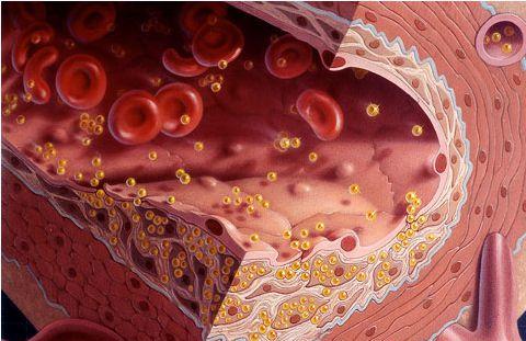 Dyslipidemia - The cause and how to prevent